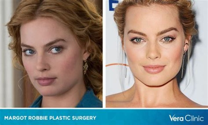 Unveiling The Truth: Has Margot Robbie Had Surgery?