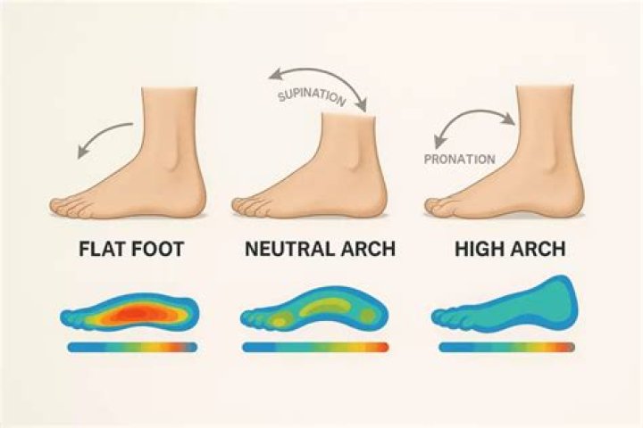 What Are High Arch And How To Fix Them! Marietta Foot Doctor