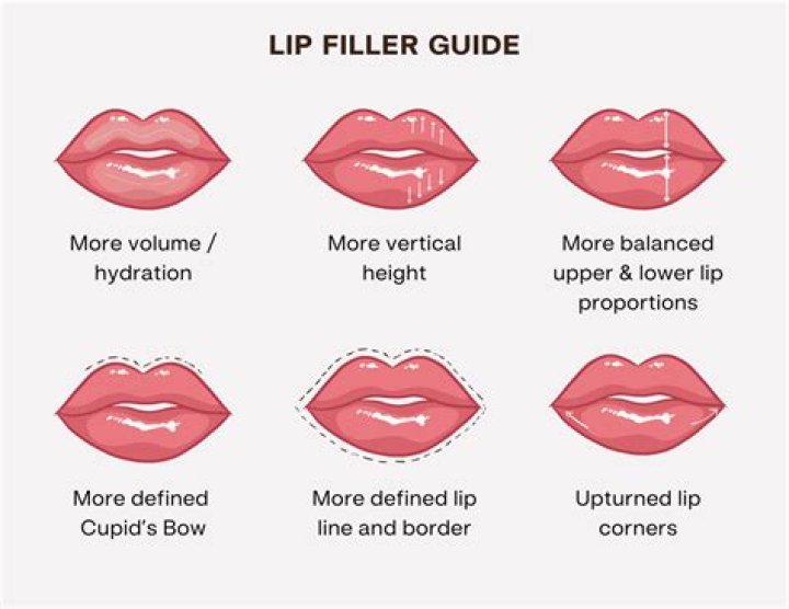 What Are Lip Fillers? Information from VIVO Clinic