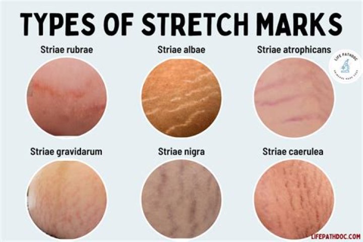 When Do Stretch Marks Start In Pregnancy? (Important Facts)