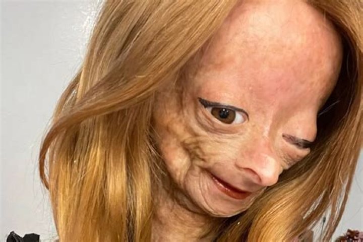 YouTuber Adalia Rose, Who Had Rare Rapid Aging Condition, Dies Aged 15