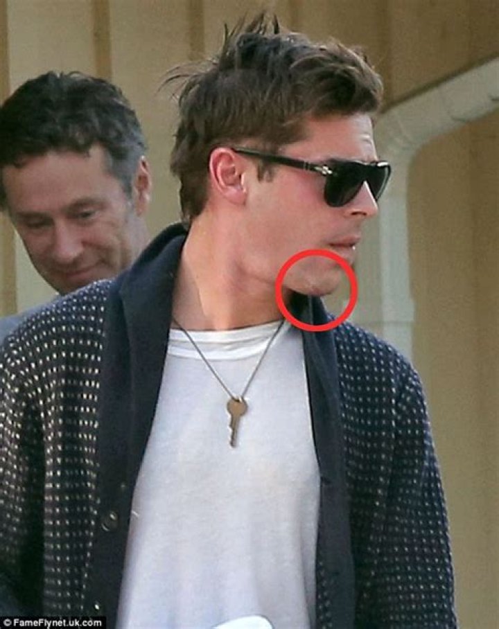 Zac Efron Chin Accident